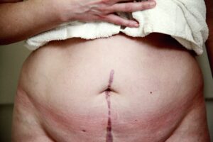 Was sind Keloide? Ursachen & effektive Behandlungen